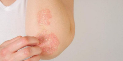 Kenali Ragam Pengobatan & Pencegahan Psoriasis