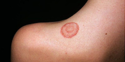 Viral Berita Penyakit Kulit Ringworm, Hati-hati Tertular!