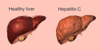 Hepatitis C, Sillent Killer yang Sebabkan Peradangan dan Kerusakan Hati Serius