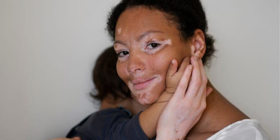 Hari Vitiligo Sedunia 2024 Angkat Tema United by the Skin: Merangkul Keberagaman dan Mengapresiasi Kecantikan Unik Setiap Individu