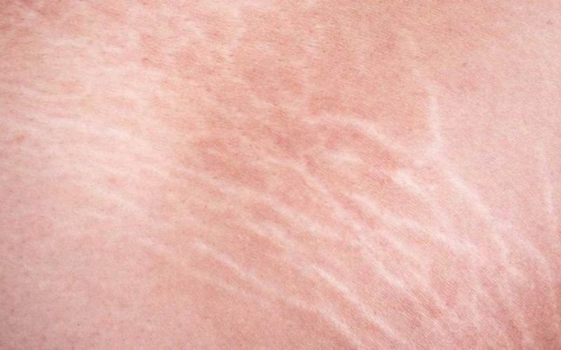 Contoh stretch marks pada kulit/Pinterest 